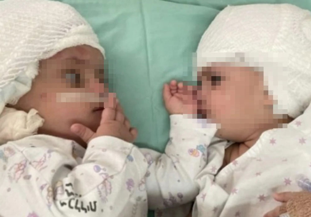 In Israele operazione chirurgica di 12 ore per separare due gemelle siamesi